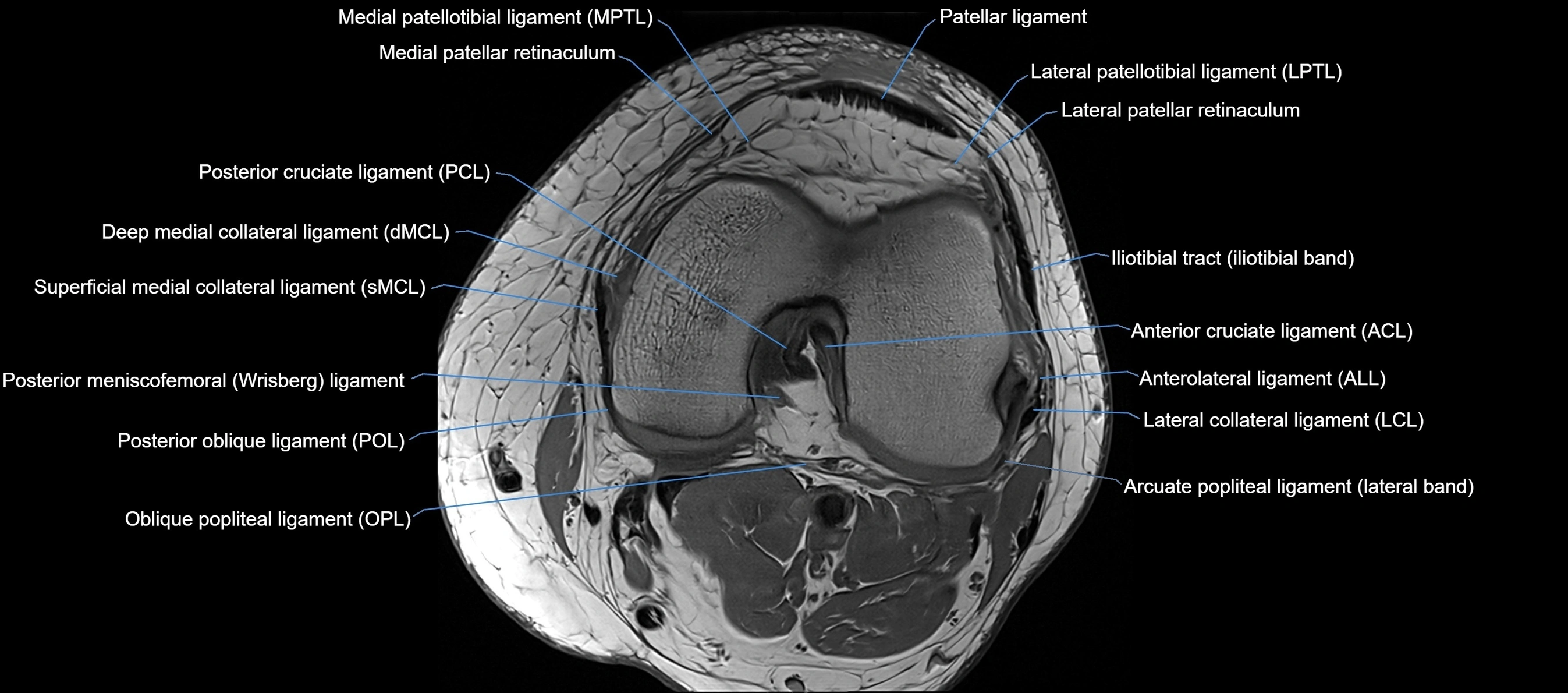 MRI Knee axial  ligaments cross sectional anatomy 3T  radiology  image-img-03001-00025.webp